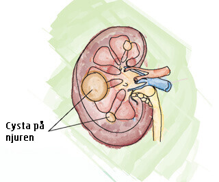 Cysta på njuren