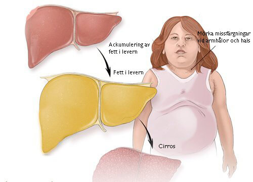 Fett i levern: vad är det och vilka är symtomen?