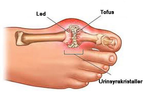 Symtom och effektiva behandlingar för gikt