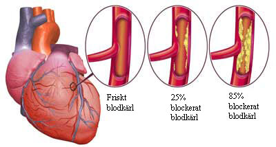 Svullna ben, anklar och vener i nacken är symtom på hjärtsvikt