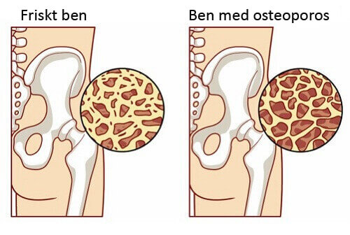 osteoporos osteoporos