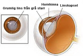 Lins hos person med grå starr