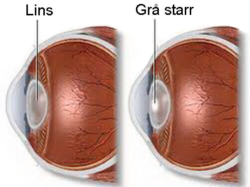 Grå starr