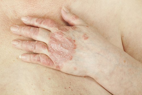 Psoriasis och eksem kan också orsaka vaginal klåda