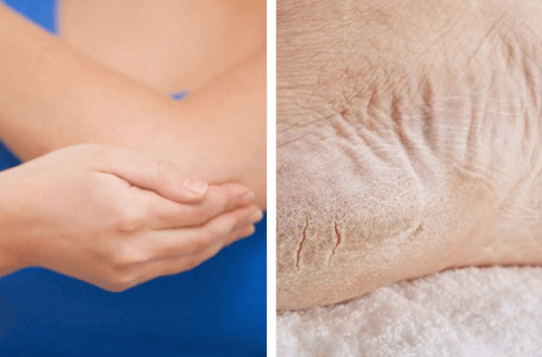 Behandla torra armbågar och fötter på en vecka