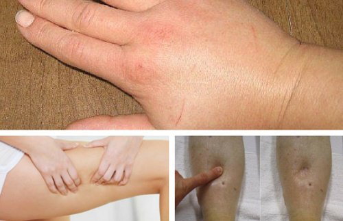 7 naturliga diuretika som hämmar vätskeretention