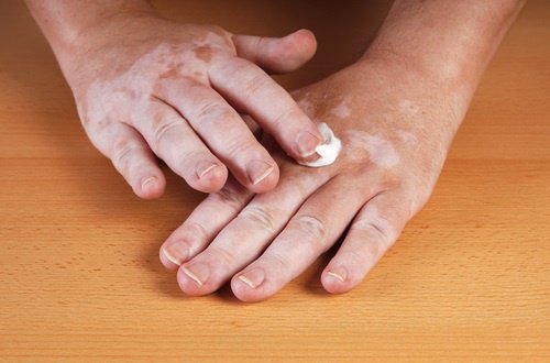 Vitiligo: Vad är orsaken och hur behandlar man det?