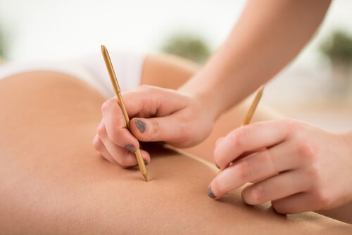 Akupunktur