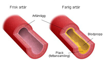Ateroskleros