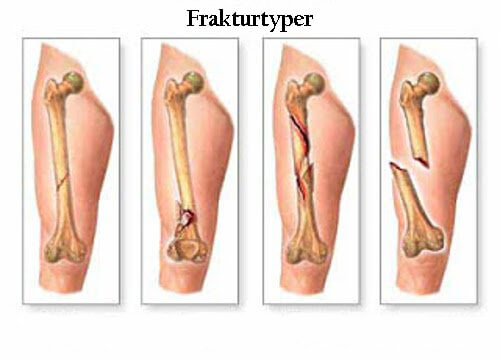 De 5 främsta symtomen på skelettcancer