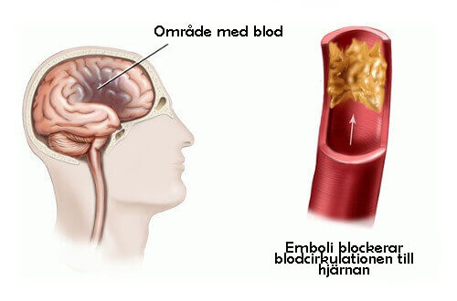 Stroke hos kvinnor - här är några riskfaktorer