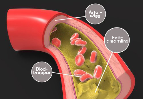 Hur du naturligt minskar mängden triglycerider