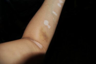 Arm med vitiligo