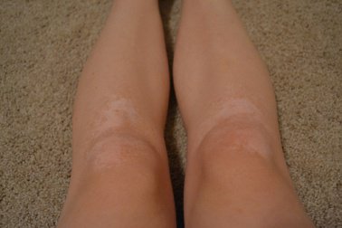Vitiligo på benen