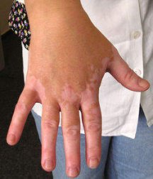 Vitiligo på handen