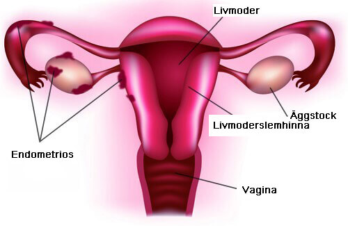 Endometrios Endometrios