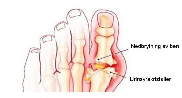 Urinsyra kan leda till njursten