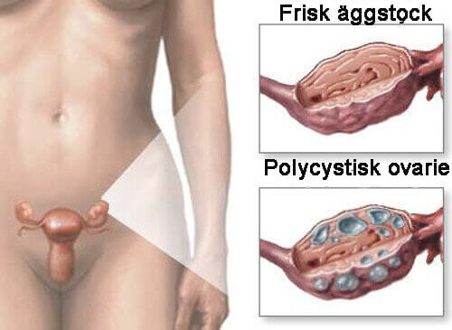 polycystiskt ovariesyndrom polycystiskt ovariesyndrom