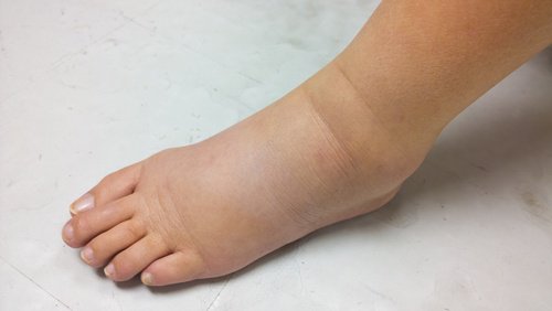 Vätskeretention i vävnaderna orsakar inflammation