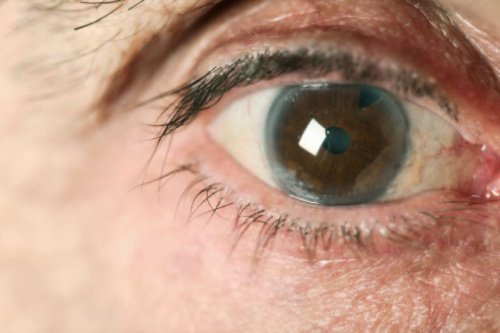 Hur man naturligt motverkar glaukom