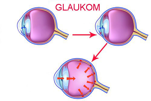 glaukom