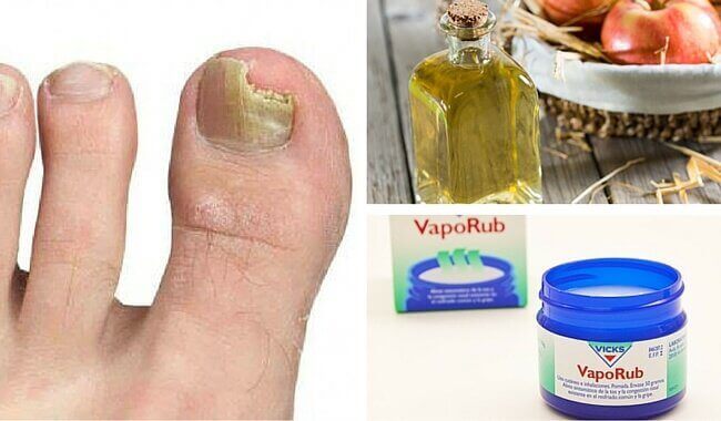 6 helt naturliga botemedel för att behandla nagelsvamp