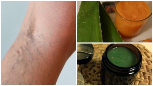 Effektivt gammalt husmorsknep mot åderbråck