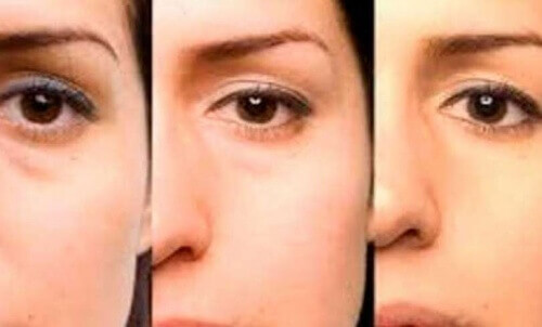 Råd för att bli av med påsar under ögonen