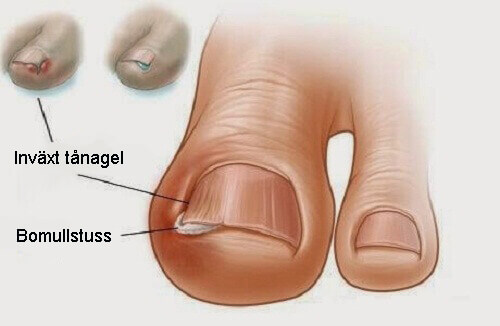 6 gamla kurer för inåtväxande tånaglar