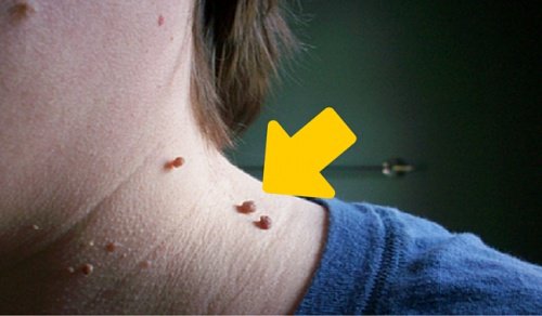 6 tips för att naturligt ta bort hudflikar