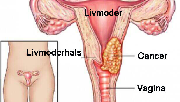 7 faktorer som kan leda till livmoderhalscancer