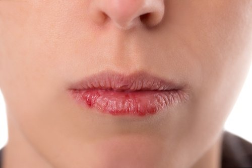 En torr mun är ett tecken på vätskebrist