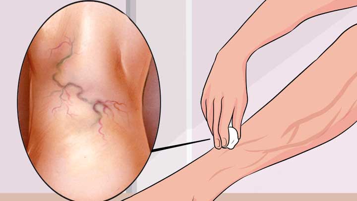 Prova på en naturlig behandling av åderbråck