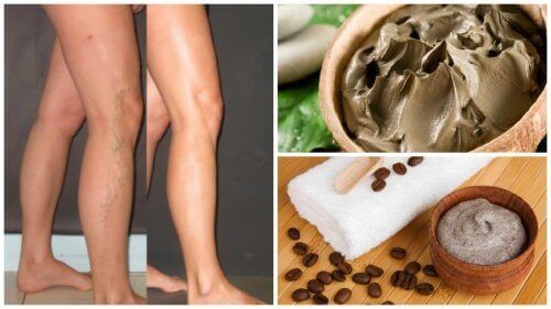 5 naturliga sätt att bekämpa åderbråck