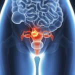 endometrios