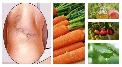 Naturlig behandling av åderbråck med 3 ingredienser