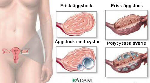 9 fakta om ovarialcystor som alla kvinnor bör ha koll på