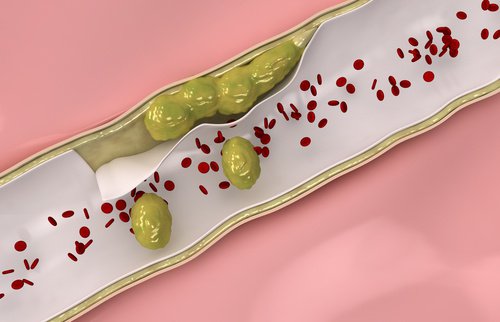 1-clean-arteries