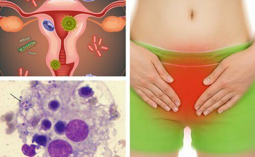 Tips för att lindra vaginala svampinfektioner
