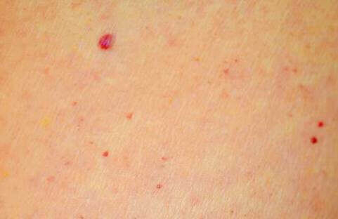 röda fläckar kan vara bra att kolla upp