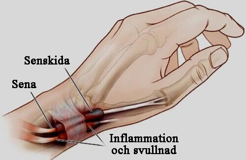 Tenosynovit: inflammation i händer och fötter