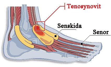 tenosynovit