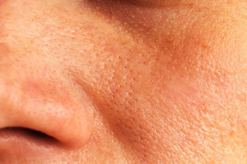 8 huskurer för att minska stora porer