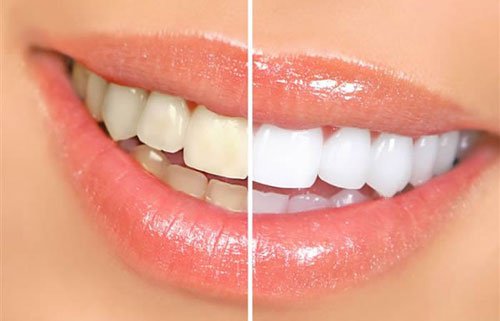 8 livsmedel som ger dig gula tänder
