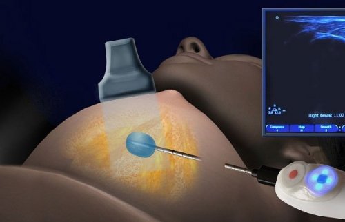 Fryskirurgi: Ett nytt behandlingsalternativ för bröstcancer