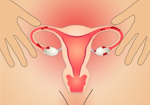 Endometrios