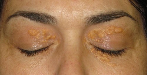 Xantelasma: vita fläckar runt ögonen