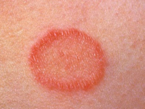pityriasis på huden