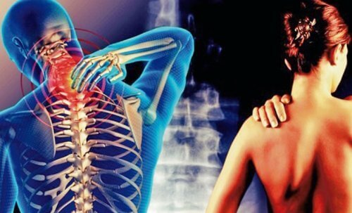 Cervikobrakialt syndrom: smärta i nacken ned till armarna