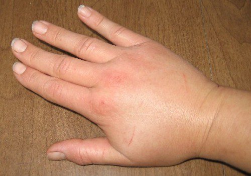 svullen hand